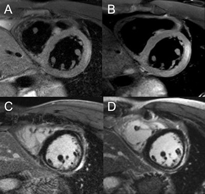 Image comparison in assessment of myocarditis in patient with initial examination performed at 1.5 tesla (A,C) and follow-up at 3 tesla (B,D). T2-weighted spectral attenuated inversion recovery (SPAIR) for assessment of edema (A,B), as well as late gadolinium enhancement imaging (C,D), show improved image quality with higher spatial resolution at 3 tesla. Images courtesy of Dr. Bernd Wintersperger.