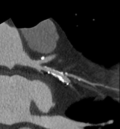High-definition cardiac CT image obtained on GE Healthcare's Discovery CT750 HD shows stenosis adjacent to stent. (Provided by GE)