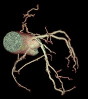 High-definition cardiac CT image obtained on GE Healthcare's Discovery CT750 HD shows bronchial vessels. (Provided by GE)