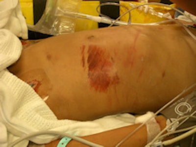 External markings and abdominal distension due to the trauma. Image courtesy of Dr. David Kessel.