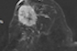2012 02 27 17 20 06 400 2012 03 01 Breast Dwi Thumb