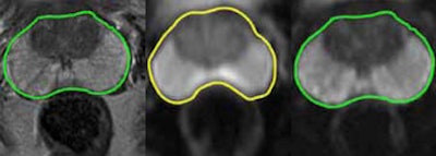 2012 02 28 16 57 27 403 Early Prostate Zoom 450