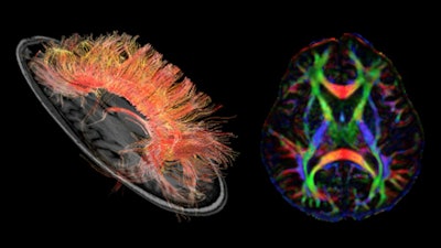 2012 02 28 16 57 29 876 Discovery Mr750w 3 0 T Neuro Dti Clinical 450