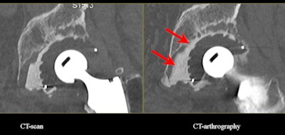 2012 02 28 17 50 31 934 Acetabular Loosening 450