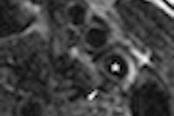 2012 02 28 18 17 52 29 2012 Vulnerable Plaque Thumb