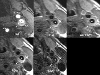 2012 02 28 18 17 54 794 2012 Vulnerable Plaque 450