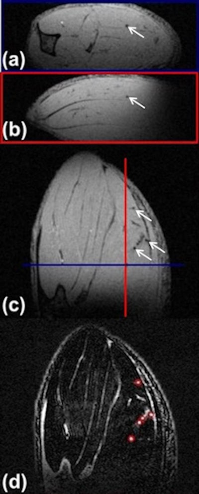 High-resolution 3D MR image of (A) axial, (B) sagittal, and (C) coronal slices of the calf muscle of a mouse treated with M0 macrophages subpopulations at 24 hours postinjection, showing signal voids that are punctual (white arrows) and do not correspond to vessels. (D) Example of the processed image, which allows the quantification of hypointense punctual regions. (Figure provided by Prof. Olivier Clément)