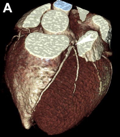 Images Are Of A 42 Year Old Man With Atypical Chest Pain And No Significant Ecg Or Troponin Alterations
