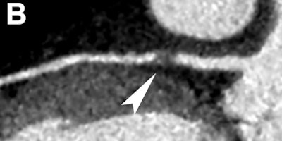 2012 03 09 09 56 56 877 Cta Chest Pain Bottom 394