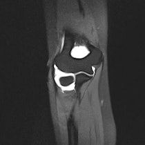 The London 2012 medical team is preparing to treat sports injuries like this partial thickness injury of the distal ulnar collateral ligament, diagnosed by an elbow MR arthrogram. Image courtesy of Dr. Phil O'Connor.