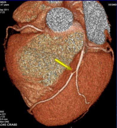Above and below: In a 47-year-old asymptomatic woman who smoked five to 10 cigarettes per day, CCTA revealed a 74% stenosis (noncalcified plaque) in the proximal left anterior descending artery, with no other significant stenoses in the coronary vessels. In this case, risk stratification schemes would clearly underestimate the patient's cardiovascular risk, even considering her strong family history of having two first-degree relatives who suffered myocardial infarction before age 50, as genetic burden has not been well-studied in young patients. The effective radiation dose was 1.8 mSv. All images courtesy of Dr. Alberto Hidalgo.