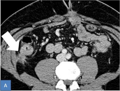 Stellate pattern. Axial contrast-enhanced CT shows a solid nodular implant (arrow) located in right paracolic gutter. That nodule is characterized by spiculated contours providing a stellate pattern.