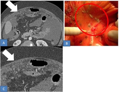 Micronodular pattern in a 60-year-old woman with ovarian cancer. A: Axial contrast-enhanced CT image shows tiny 4-5 mm solid implants (arrow) involving the parietal serous layer. B: Intraoperative image of micronodular implants (circle). C: Magnification of axial CT image.