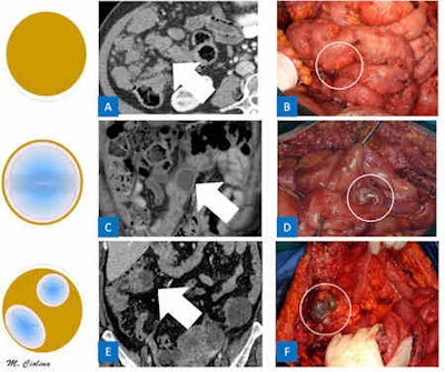 Different aspects of peritoneal implants. A: Axial contrast-enhanced CT scan shows solid implants (arrow) presenting as several homogenous soft-tissue nodules. B: Intraoperative image of solid implants (circle). C: Coronal contrast-enhanced CT image shows cystic implant (arrow) over small bowel loops appearing hypodense due to the internal fluid component. D: Intraoperative image of cystic implants (circle). E: Axial contrast-enhanced CT image shows 4-cm implant of peritoneal carcinomatosis (arrow) presenting as an ovular shape and a mixed structure consisting of a mucinous cystic component and a solid irregular rounded wall showing contrast enhancement. F: Intraoperative image of mixed implants (circle). All images courtesy of Dr. Maria Ciolina and Dr. Andrea Laghi.