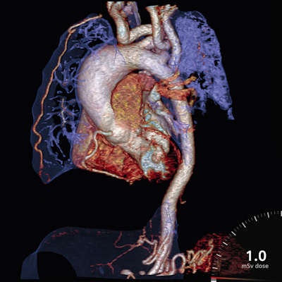 Tetralogy of Fallots case captured by Carol Young of Great Ormond Street Hospital for Children NHS Foundation Trust. Image courtesy of Siemens.