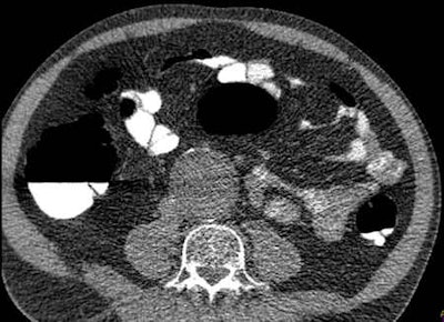Large abdominal aortic aneurysm