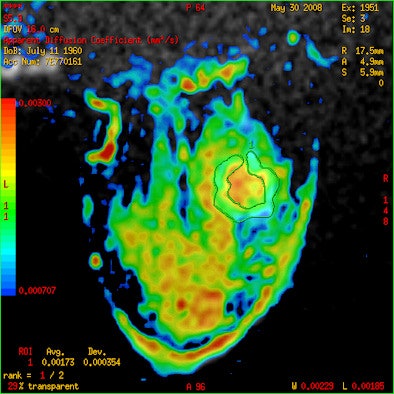 Woman with HER2-enriched invasive ductal breast cancer