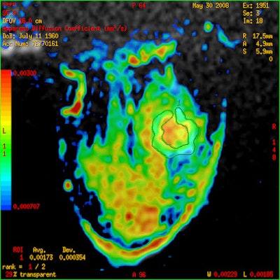 Woman with HER2-enriched invasive ductal breast cancer