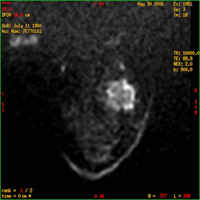 Woman with HER2-enriched invasive ductal breast cancer