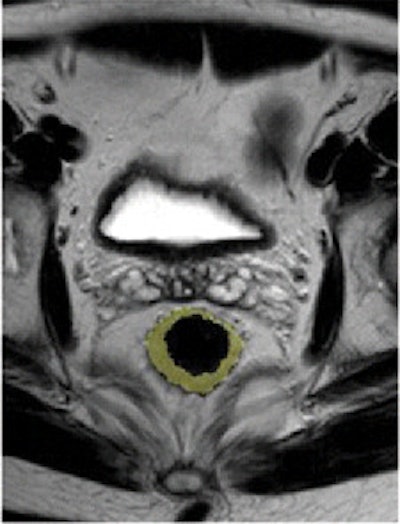 After therapy, the T2-weighted fast spin-echo axial oblique MR image (left) and tumor volumetric image (right) show no tumor response in the same patient. Post-treatment tumor volume was 45 cm3.