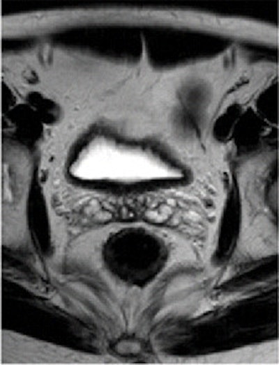 T2-weighted fast spin-echo axial oblique MR image