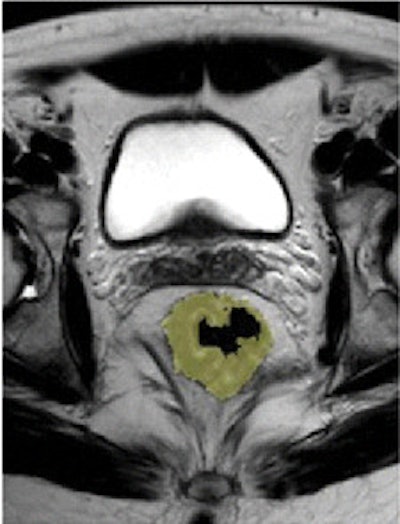 T2-weighted fast spin-echo axial oblique MR image (left) and tumor volumetric image (right) of a 54-year-old man before chemotherapy/radiation treatment. Pretreatment volume was 54 cm3. All images courtesy of Radiology.