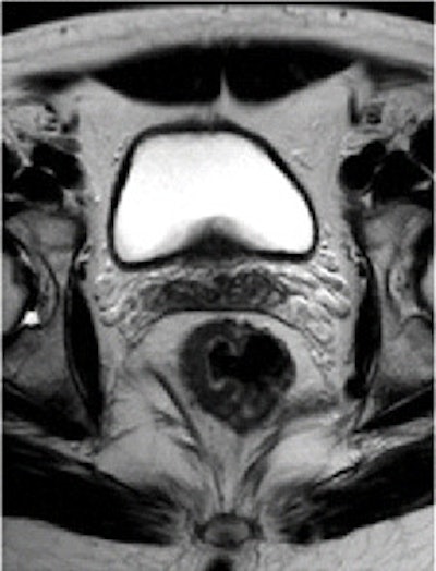 T2-weighted fast spin-echo