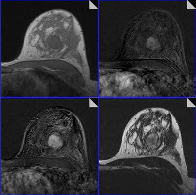 breast MRI exam enhancing lesion