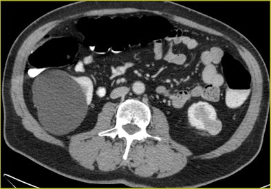 CTC after incomplete colonoscopy at the transverse colon
