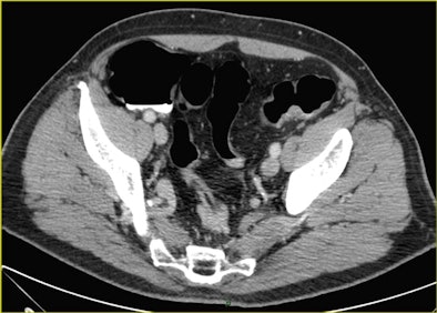 CTC after incomplete colonoscopy at the transverse colon