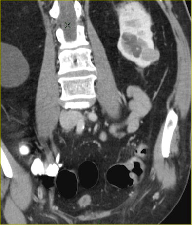 CTC after incomplete colonoscopy at the transverse colon