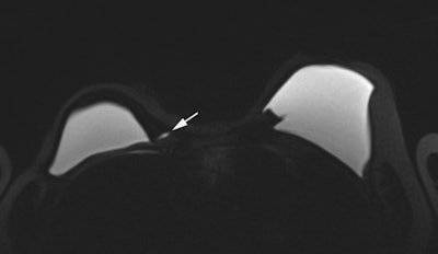 Top and bottom: Two breast MRI examinations acquired with a silicone dedicated sequence. Silicone gel appears bright, and fat and glandular tissue are dark. In cases of perspiration or rupture, an amount of bright fluid is seen outside of the implant (arrows), which facilitates diagnosis. Perspiration was not diagnosed on ultrasound in these two cases. Images courtesy of Dr. Corinne Balleyguier.