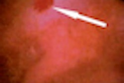 2012 04 04 08 51 52 412 2012 04 04 Gi Bleeding Thumb