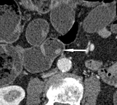 Small, benign polyp (arrow) of the jejunum measuring 6 mm in diameter is shown in an 84-year-old man who was investigated for obscure gastrointestinal bleeding. The lesion is detected with CT enteroclysis, with a high degree of confidence, whereas video capsule endoscopy failed to reveal the lesion.