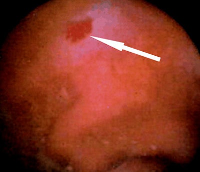 Video capsule endoscopy findings in a 72-year-old woman with obscure gastrointestinal bleeding. Whereas video capsule endoscopy reveals flat, vascular lesion of the distal ileum (arrow), CT enteroclysis failed to depict the vascular abnormality due to limited contrast resolution. Detection of flat, vascular lesions is a well recognized limitation of CT enteroclysis, and is the area in which video capsule endoscopy is markedly superior to CT enterography and CT enteroclysis. All images courtesy of Dr. Philippe Soyer.