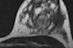 2012 04 04 11 45 17 882 2012 04 05 Breast Mri