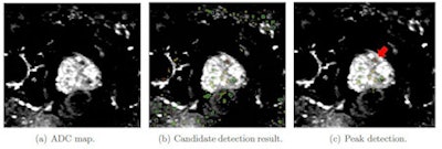 Cross-sectional transversal views of an example apparent diffusion coefficient (ADC) map of a patient with a tumor in the transition zone. (a) Multiple dark blob-like regions are visible in and outside the prostate. (b) The ADC map is shown with the blob likelihood map displayed as a color-coded overlay. Lesion candidates are detected in the pelvis showing false positives outside the prostate. These are ignored using the prostate segmentation. (c) The remaining lesion candidates are displayed within the prostate segmentation. The (red) arrow indicates a tumor with Gleason grade 3+4 which was detected by the peak detector with the highest likelihood of all detected blobs. Image courtesy of Pieter Vos, Radboud University Nijmegen Medical Centre.