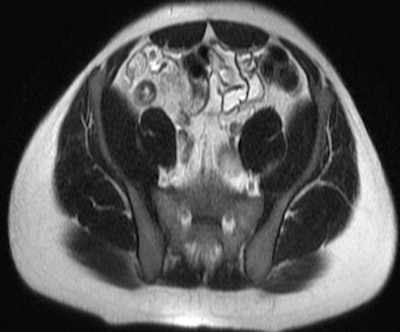 Patient with mild active terminal ileitis. All images courtesy of Dr. David Grand.