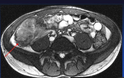 Patient with long segment terminal ileitis and extensive active inflammation. Note the matted, markedly inflamed ileal loops in the bottom two images.