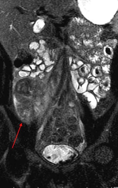 2012 04 10 11 06 23 154 2011 04 11 Mr Grand long segment terminal lower middle