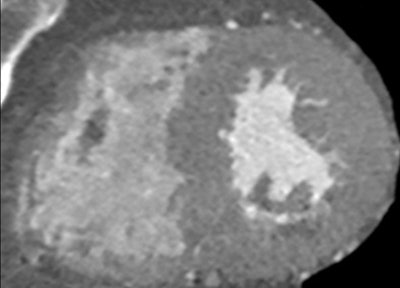 Coronary CT angiography