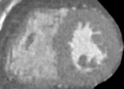 Short axis reconstruction of low dose (at 20% mAs) coronary CT angiography image reconstructed with standard FBP. In bottom image, low-dose CCTA image reconstructed with SAFIRE, demonstrates greatly improved image quality. Images courtesy of Dr. Richard Takx.