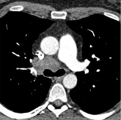 Chest CT exams obtained six months apart in a 40-year-old, obese woman (BMI: 36.5 kg/m2) referred for follow-up of thoracic malignancy. First scan performed with standard dose obtained at the level of the left pulmonary artery, and reconstructed using standard FBP (120 kVp DLP = 326 mGy.cm, Noise = 19.8 HU, and CNR = 8.1) delivers higher noise and radiation dose than low-dose SAFIRE reconstructed image from the same patient six months later, below (100 kVp DLP = 143 mGy.cm, Noise = 17.1 HU, and CNR = 9.2). Despite the dose reduction in the follow-up image, objective image noise measured at the level of the trachea was slightly reduced, and the contrast-to-noise ratio was slightly improved. Images courtesy of Dr. Julien Pagniez and Dr. Martine Rémy-Jardin.