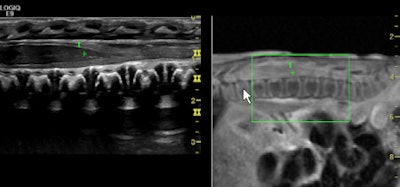 Side-by-side fusion imaging of real-time high-frequency ultrasound and MR images show the pediatric spine in a neonate with meningitis. Image courtesy of GE Healthcare.