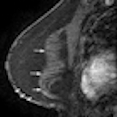 2012 04 17 12 28 03 221 2012 04 18 Mri Reconstructed Thumb