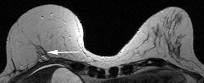 Pedicled TRAM flap-rectus abdominis muscle rotated up to the chest for breast reconstruction. Axial nonfat saturated T2-weighted images with dynamic gadolinium injection, showing the atrophied rectus abdominis muscle along the anterior chest wall (white arrow) and the bulk of the muscle in the center as against the eccentric location in the latissimus flap. The lower abdominal fat constitutes the right reconstructed breast. Normal left breast is shown for comparison.