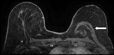 Axial fat-saturated T1-weighted subtraction image with postcontrast gadolinium injection