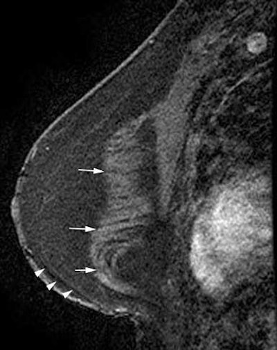 Reconstruction with latissimus dorsi myocutaneous flap: Latissimus dorsi muscle, fat and skin are rotated to reconstruct the breast. Top: Sagittal fat-saturated T1-weighted image shows latissimus dorsi muscle flipped anteriorly for reconstruction (white arrows) and the denuded dermal layer is seen parallel to the chest wall (white arrow heads). Bottom: Axial fat-saturated T1-weighted subtraction image with postcontrast gadolinium injection, the flap consisting of the latissimus dorsi muscle and its overlying skin and fat flipped and tunneled from the back to the neobreast (white arrow), giving a tailed appearance to the muscle in the lateral breast. This can be used as a differentiator on imaging from transverse rectus abdominis myocutaneous (TRAM) flap reconstruction. All images courtesy of Dr. Vandana Dialani.
