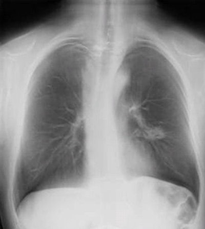 Digital chest tomosynthesis uses an upgraded DR system with a panning tube head. Image courtesy of Dr. Luca Bertolaccini.