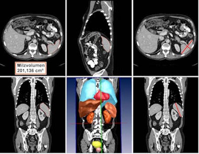 Automated detection and volumetry of spleen (delineated with red boundary lines) in axial (top left), sagittal (top center), and coronal plane (bottom left). Automated detection and volumetry of several organs in 3D view (center bottom). Top left and top right show manual measurements of the spleen. All images courtesy of Dr. Matthias Hammon.